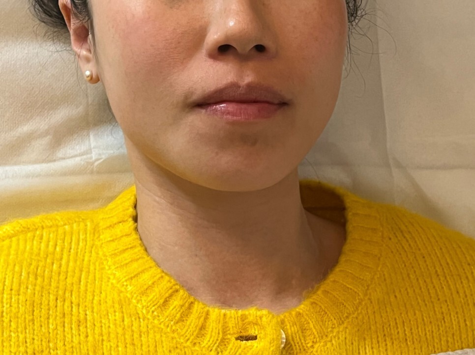 온다 리프팅 후기