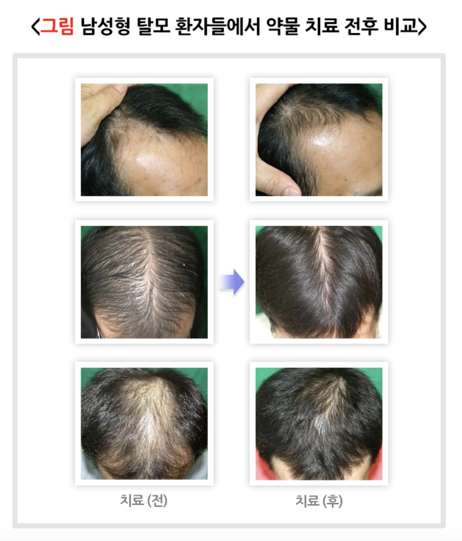 약물 치료 전후 비교