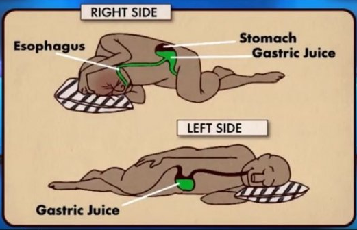 역류성식도염에 좋은 옆으로 눞는 방법 설명