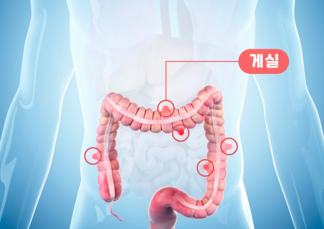대장게실염-위치사진-사람의몸속내장사진