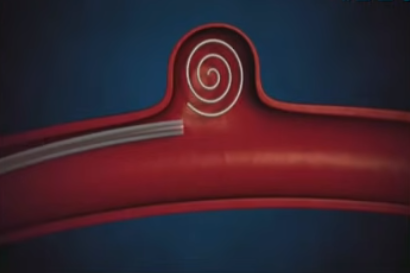 뇌동맥류 색전술