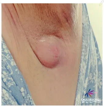 여자 오른쪽 겨드랑이 콕콕 유방암 증상일까 놓치기 쉬운 신호로_22