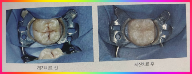 치아 레진 치료 전후 모습
