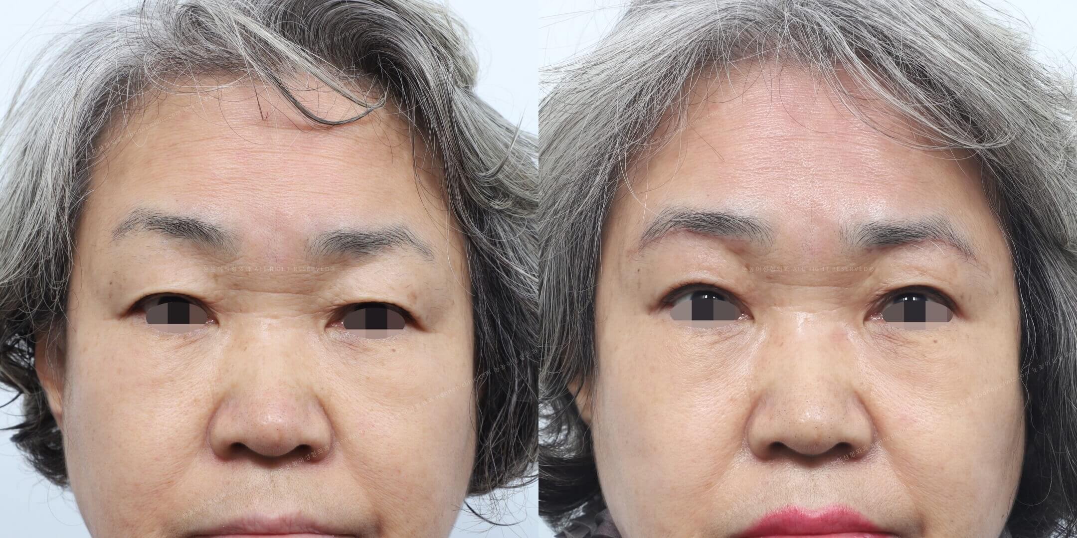 눈썹하거상