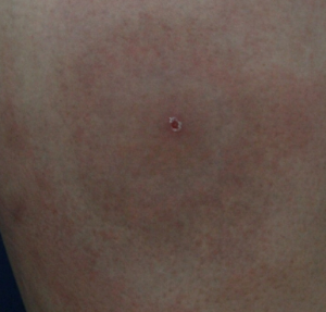 모기 물려서 가려울 때