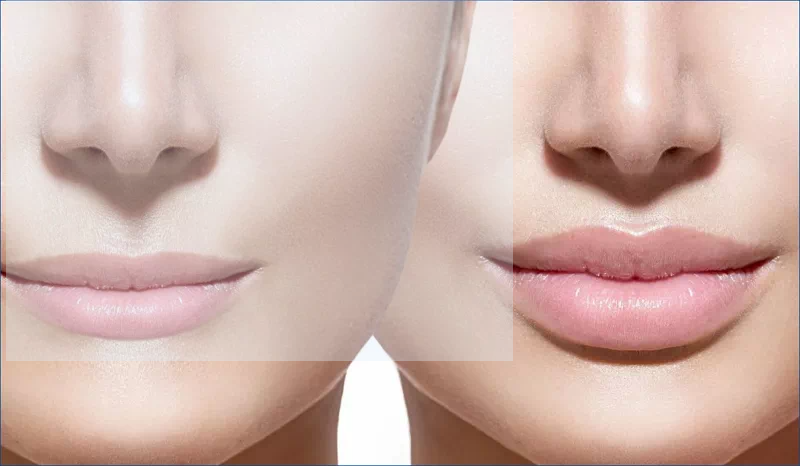 입술필러 전후