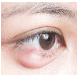 눈 다래끼 빨리 낫는 법