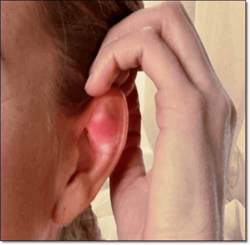 귀 켈로이드 여성