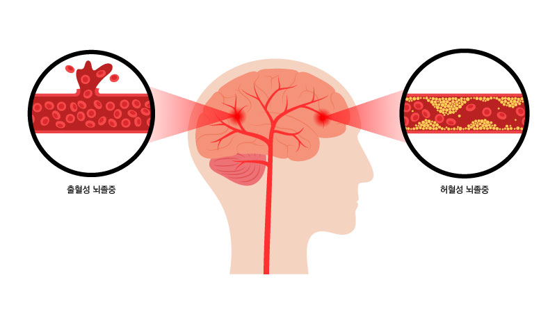 뇌졸중-전조증상-10가지