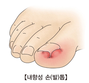 내성발톱