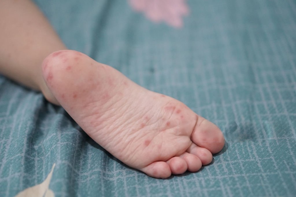 수족구에 걸린 아이 발