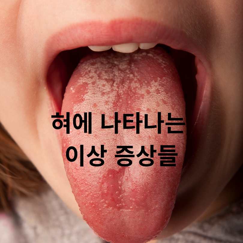 혀 건강 상태 체크법