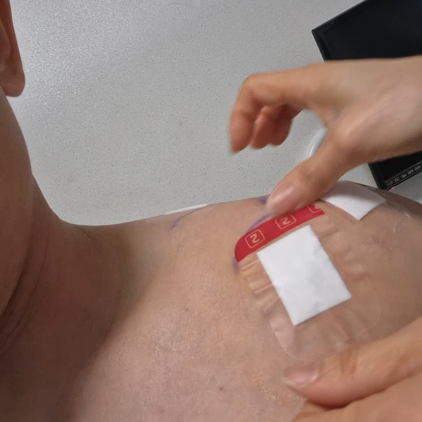 어깨 와순파열 봉합수술 후 mri사진 물리치료 기록