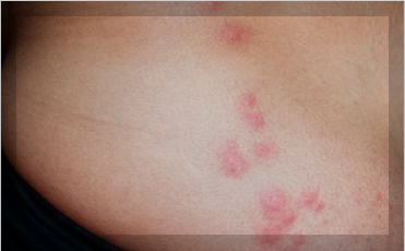 빈대 물리면 증상, 자국