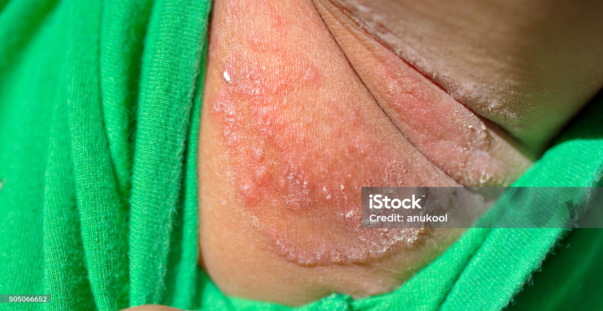 유방외 파제트병 관련 사진