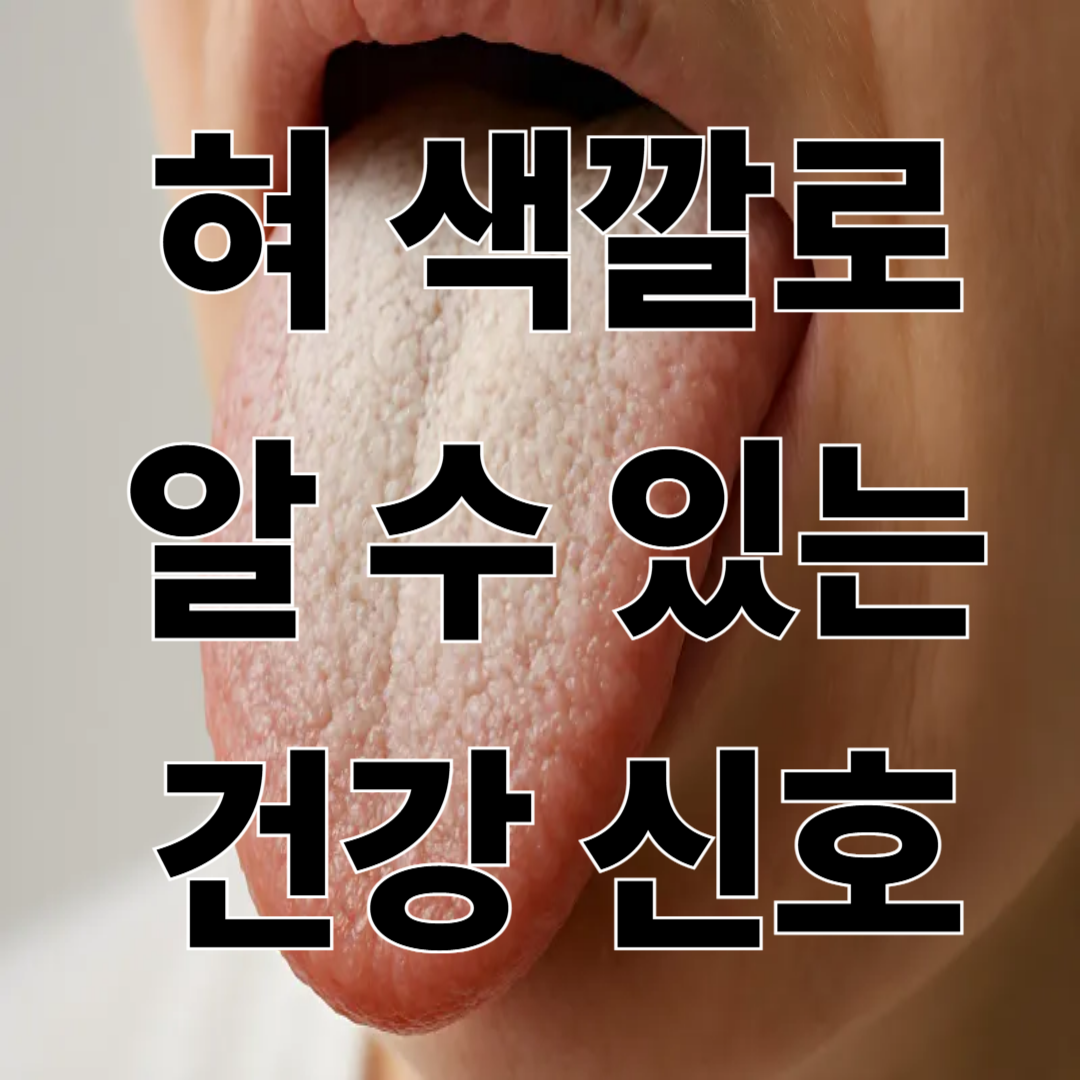 혀 색깔로 보는 건강 상태 – 설태와 질환 신호 총정리