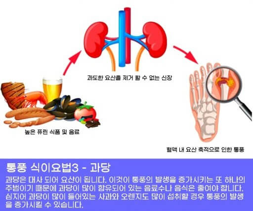 통풍의 증상