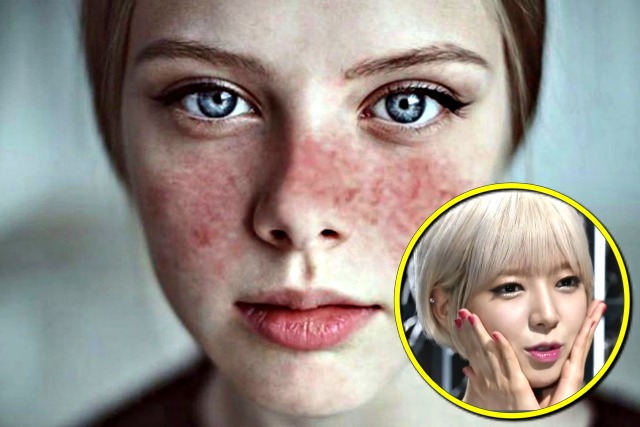 루푸스병 증상,초아,생로병사의비밀