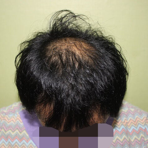 정수리-m자탈모