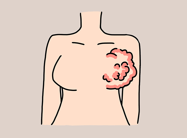 유방피부가-울퉁불퉁한-여성