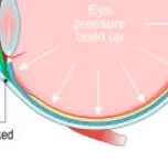 안압이 높아지는 이유 &mdash; 눈 속의 보이지 않는 압력