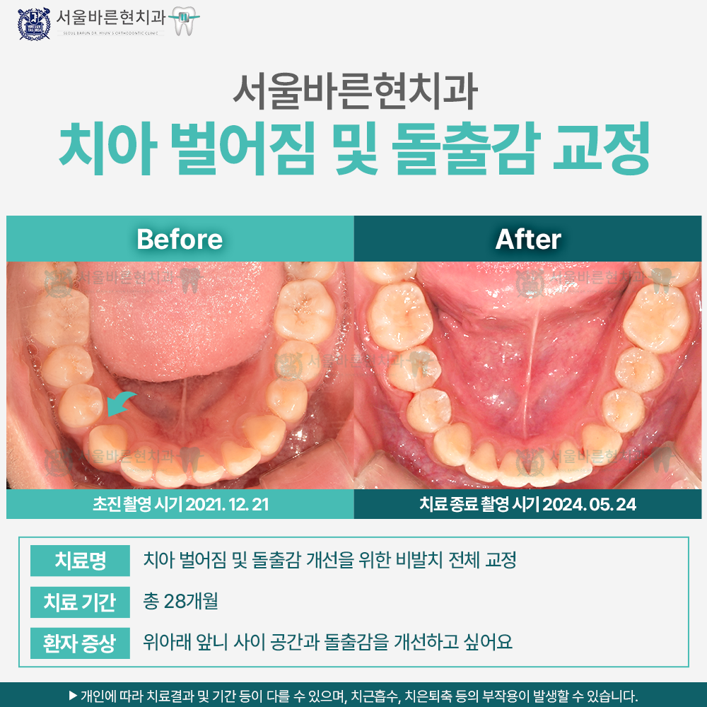 해운대 치아교정