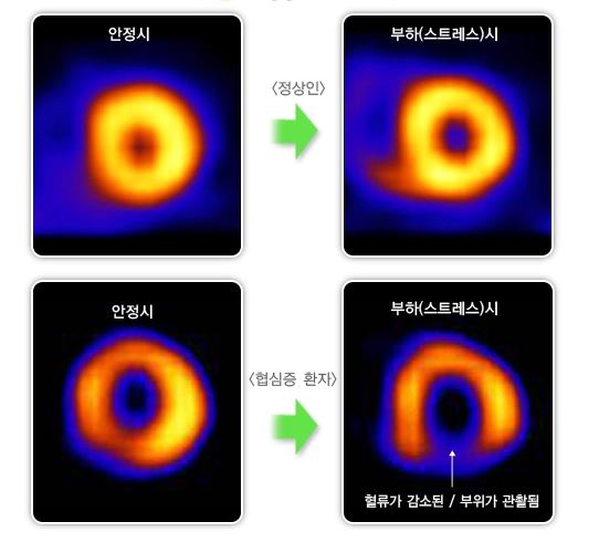 핵-영상-스캔