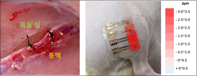 부드러운 웨어러블 마이크로니들 센서 플랫폼 기술 개발