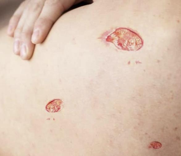 욕창 상처에서 냄새 관리 — 원인과 해결책