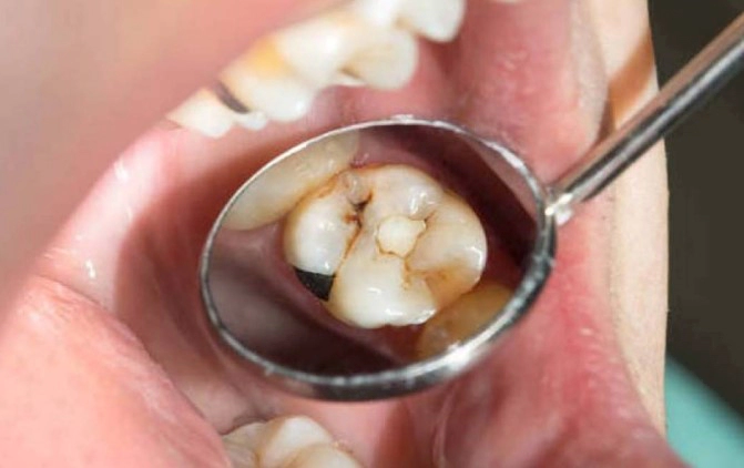 치아 우식단계별 증상 치료 