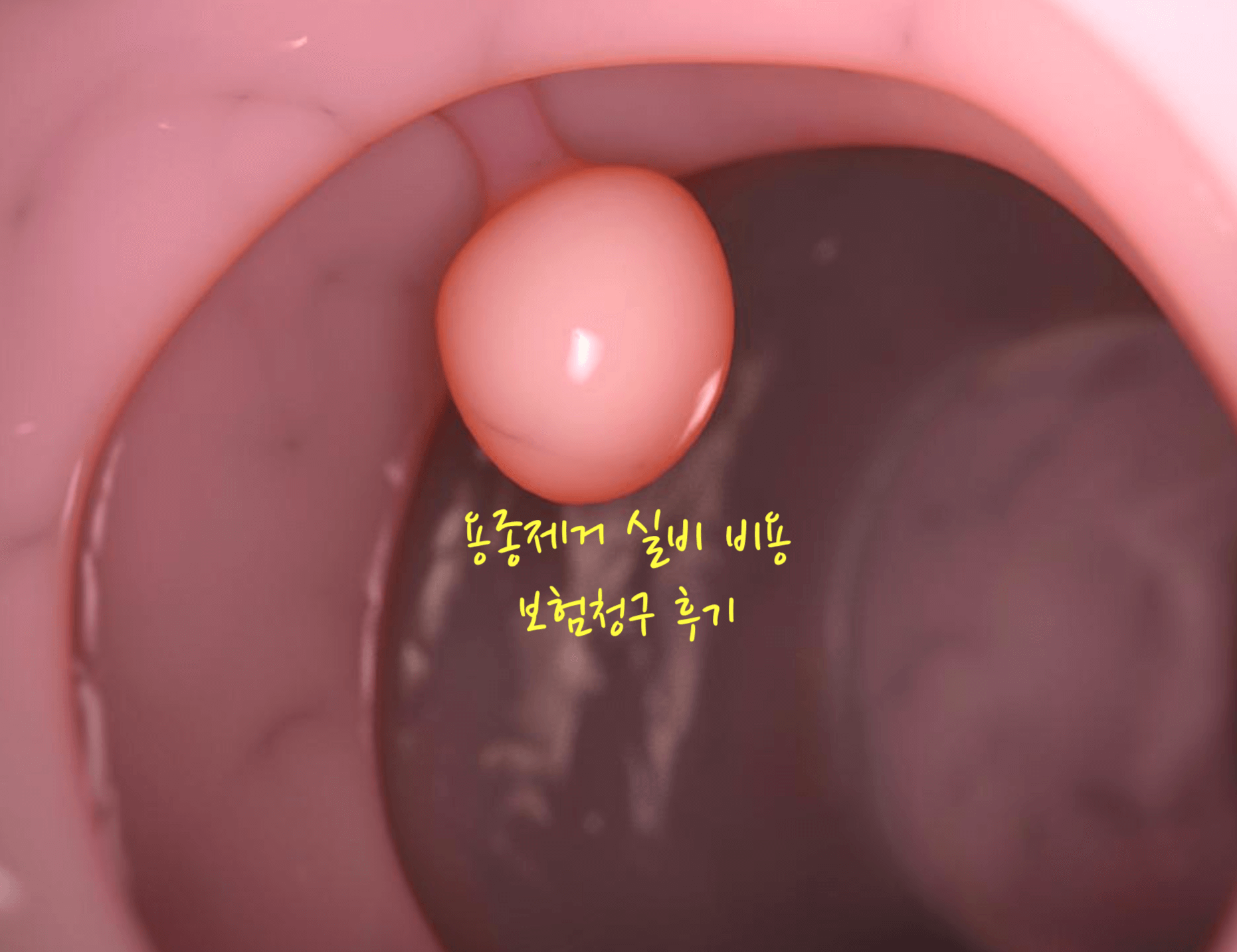 용종제거 실비