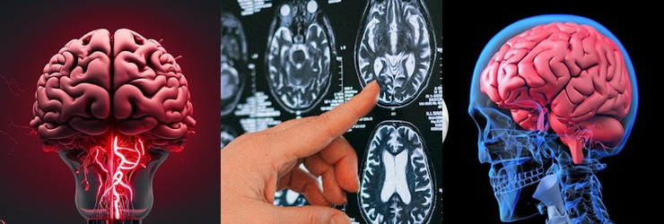 뇌혈관-전문병원