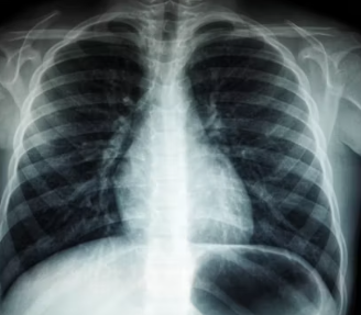 섬유근육통 진단기준 치료방법 합병증 관리