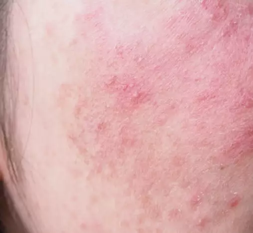 대상포진-초기증상-원인-건강