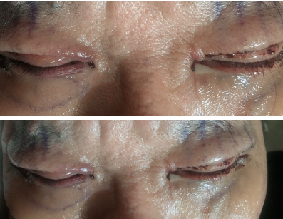 상안검 수술 후기