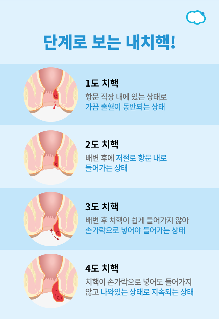 단계로 보는 내치핵/ 출처 - 네이버블로그 [MUSICINE]