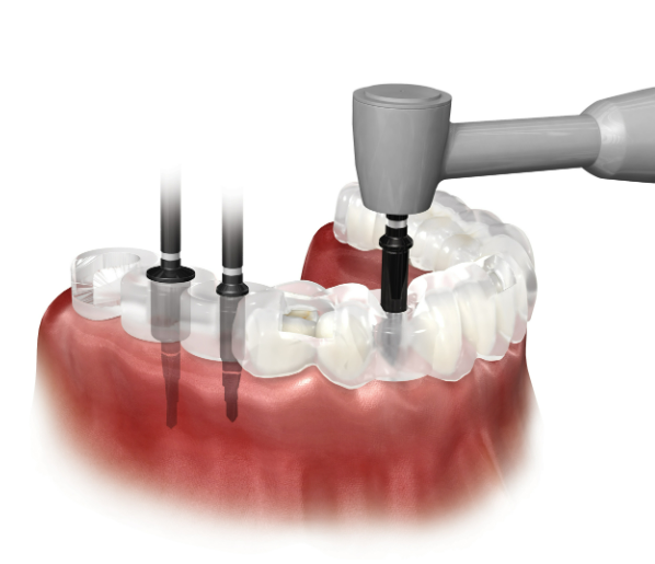 덴티움 디지털가이드 스텐트