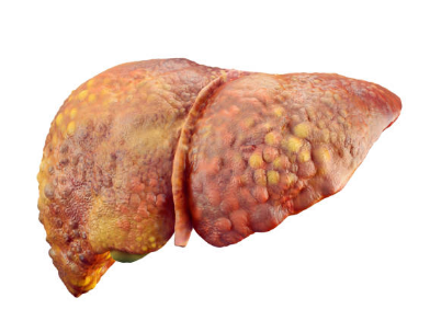 지방간 증상, 없애는 방법, 원인 총정리 (2024ver)