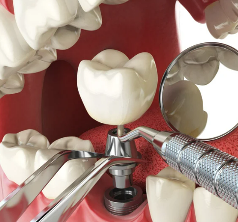 임플란트 가격 비교 사이트별 비용 총정리