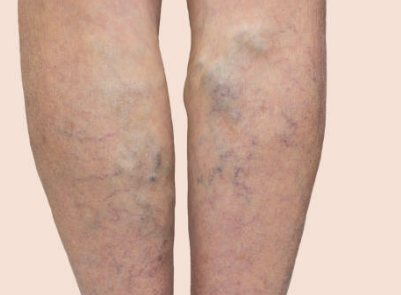 하지정맥류 증상 수술비용 좋은운동 등 총정리(2024 최신)