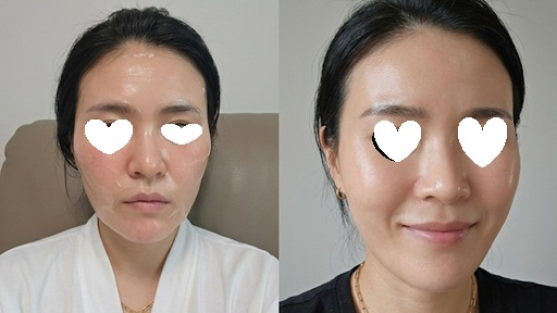 내돈내산 레이저 시술 전후 사진
