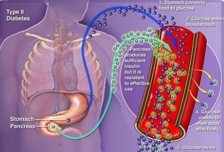 흡연과 중증 인슐린 결핍성 당뇨병 위험 증가 관련 이미지
