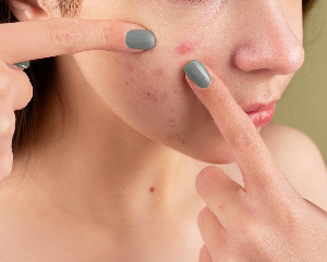 여드름 흉터 없애는 법