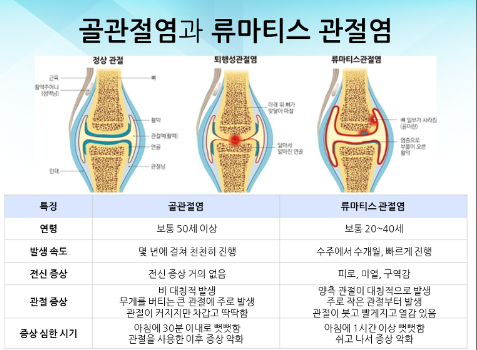 골관절염과 류마티스 관절염