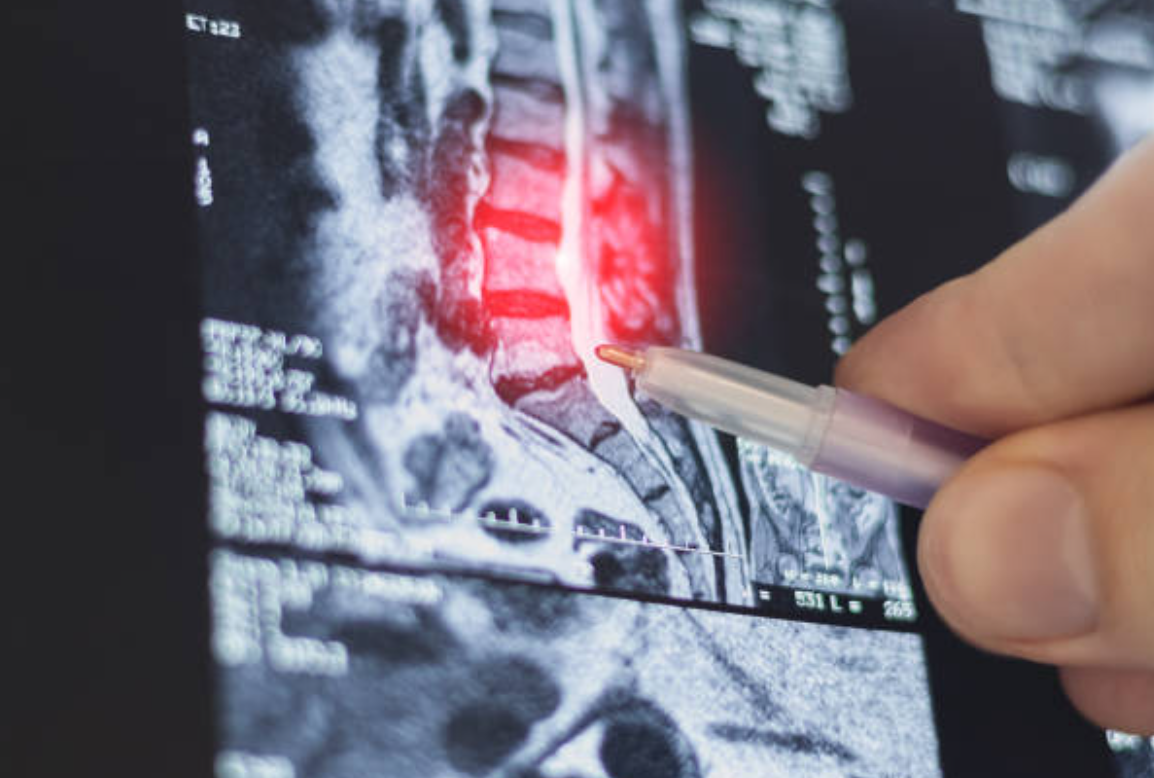 목디스크와 관련된 사진2