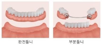 임플란트 의료보험