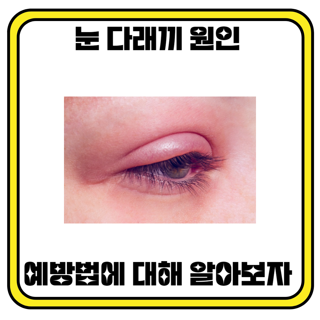 눈 다래끼 원인 및 예방법에 대해 알아보자