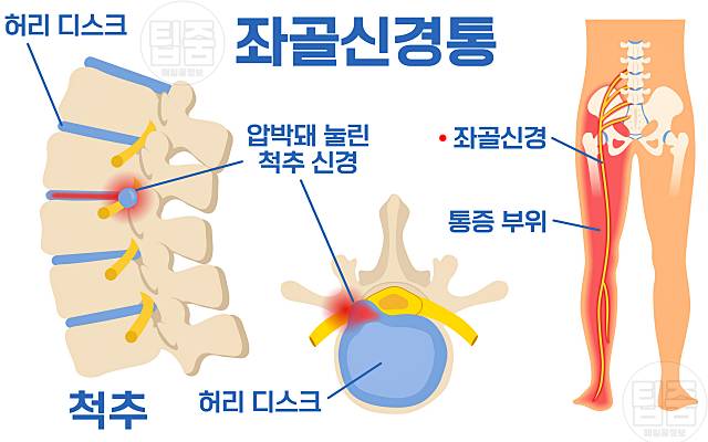 종아리 통증 원인 종아리가 땡기고 아파요 좌골신경통