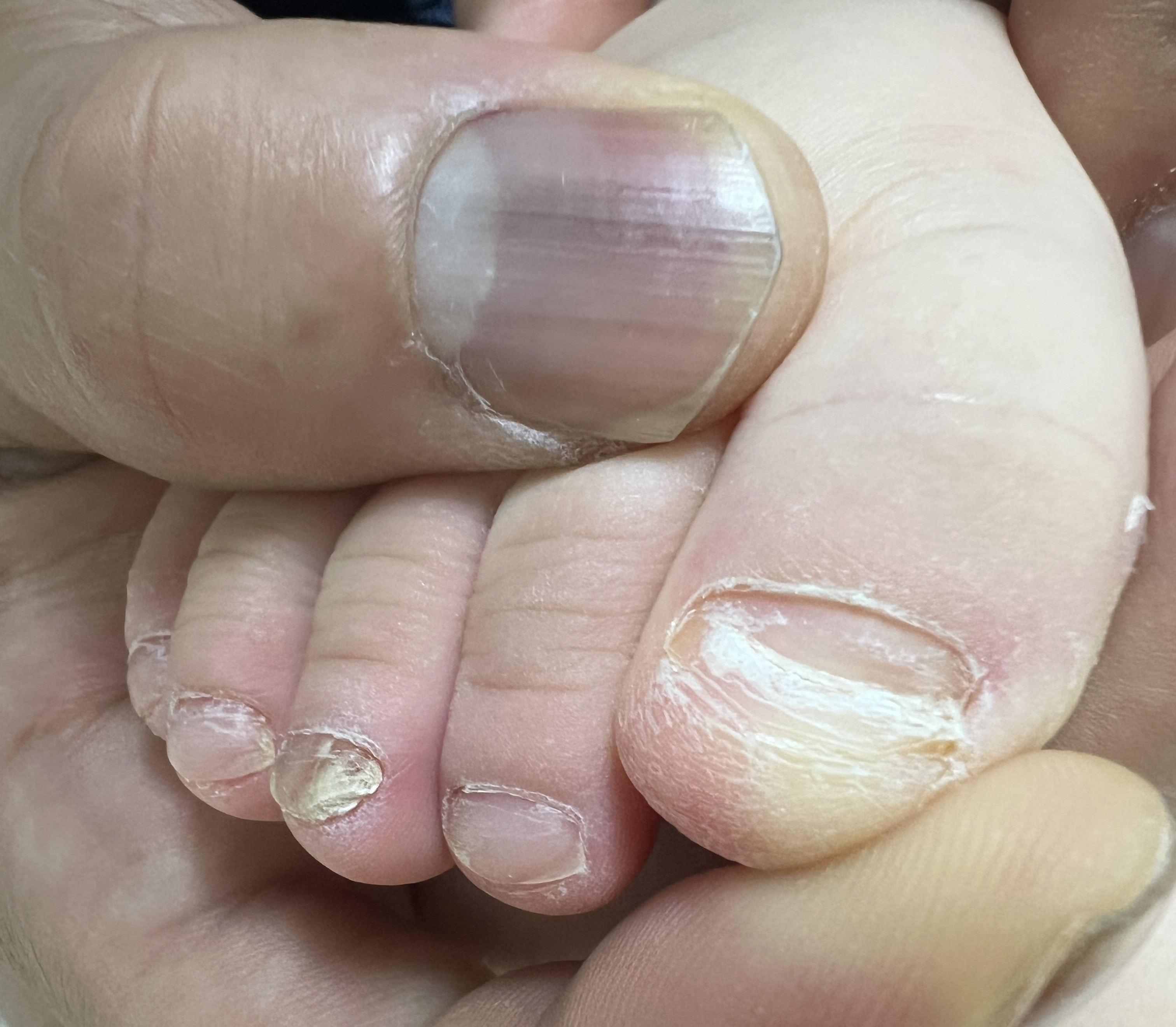 아이 발톱무좀 사진