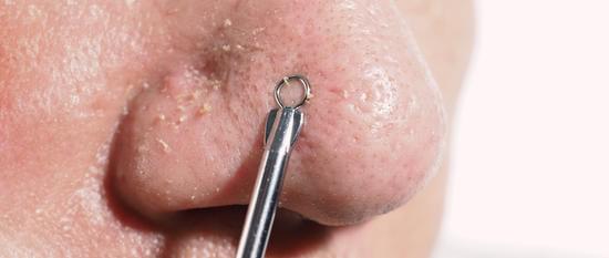 코 피지 관리 가이드: 효과적인 제거와 관리 방법